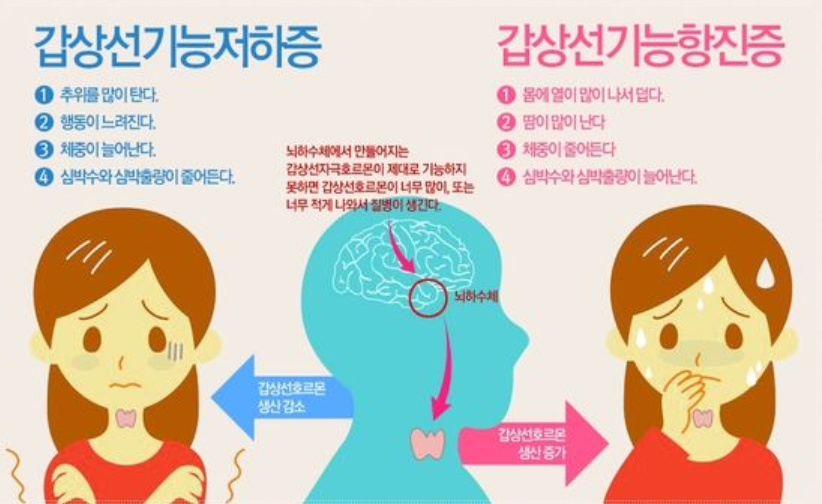 안구돌출, 갑상선 기능 항진증과의 관계 1