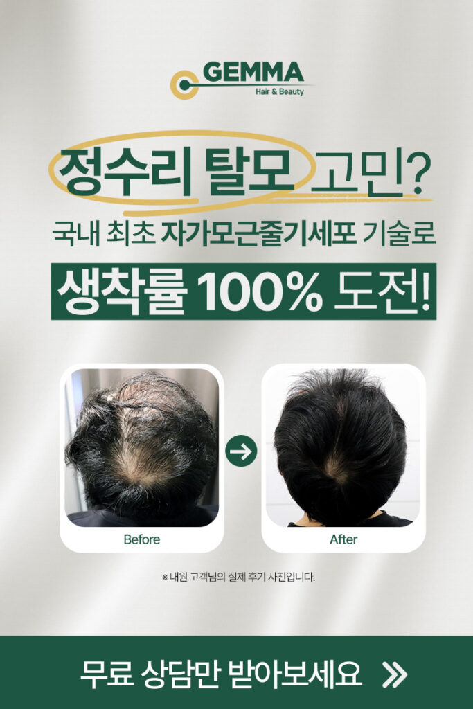 20년전 가격 그대로! 비절개 모발이식 99만원! 3