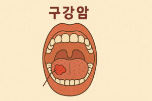 구강암 초기증상, 절대 놓치지 마세요 7