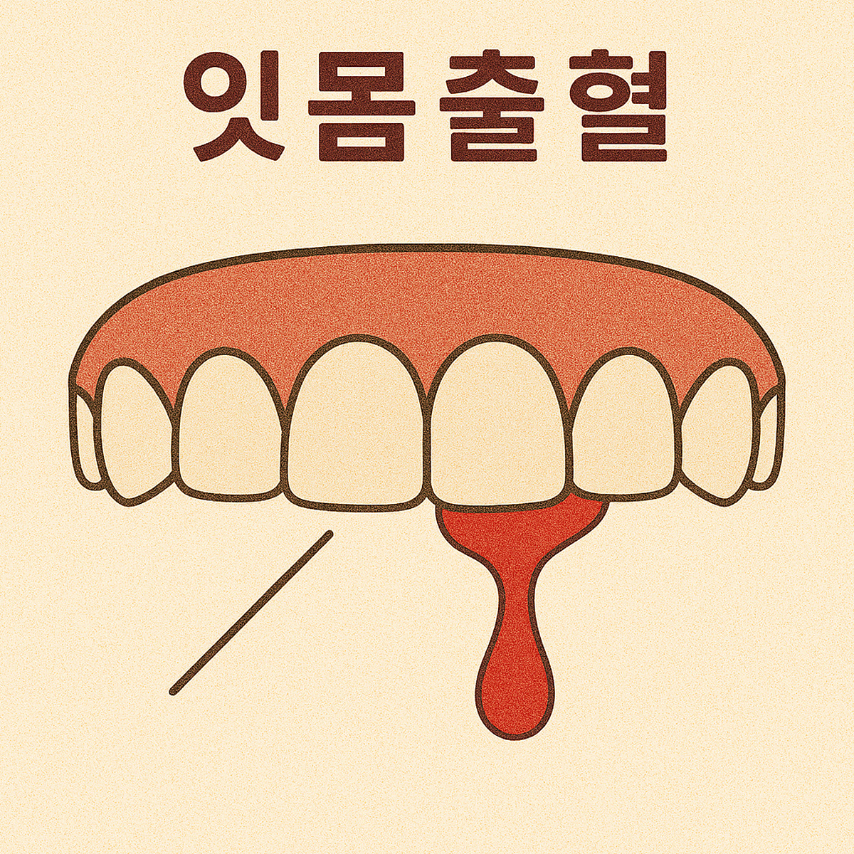 잇몸 출혈, 그냥 놔두면 안 되는 이유 1