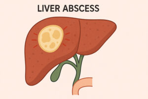 간농양, 간에 고름이 차는 병 3