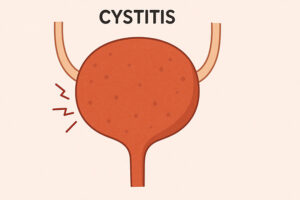 방광염, 여성에게 더 흔한 이유 6